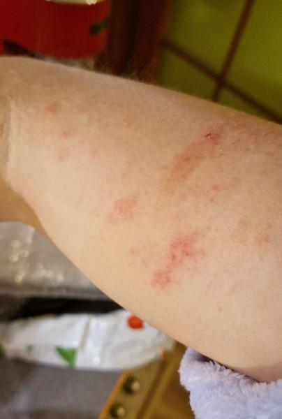 Ekzém alebo psoriáza