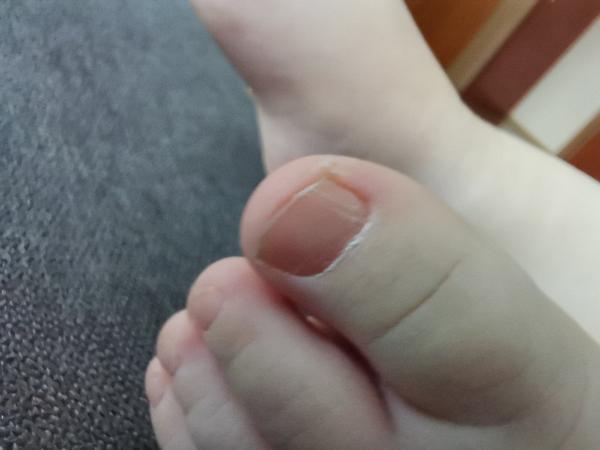 Dosť tvrdé nechty na palčekoch na nohách u 1,5 ročného dieťaťa