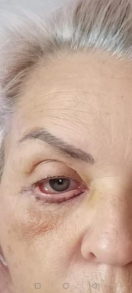 Je operácia viečok bezpečná a čo očakávať?