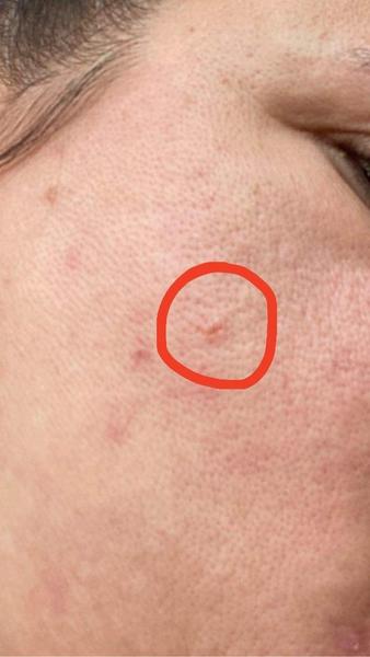 Aký kožný útvar mám na líci?