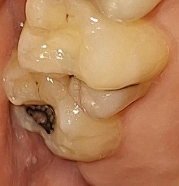 Ako zvládnuť zubný kaz počas tehotenstva?