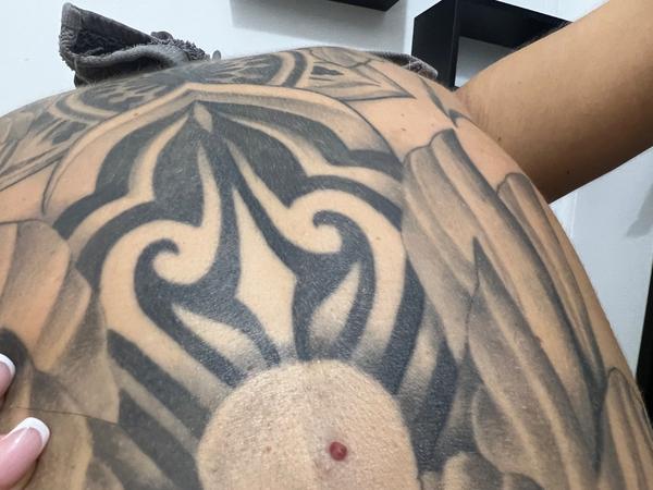 Krvácajúca vyrážka