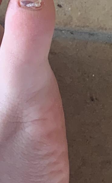 Znamienko alebo pleseň pod nechtom