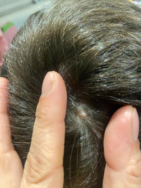 Tvrdý výrastok na hlave