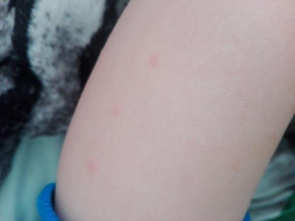 Aké vyrážky to má môj ročný syn na nohách?