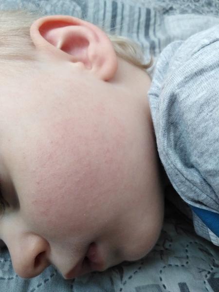 Aké vyrážky má môj 21 mesačný synček na lícach?
