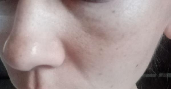 Ako sa dá zbaviť vačku pod očami?