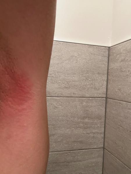 Zapálené podpazušie