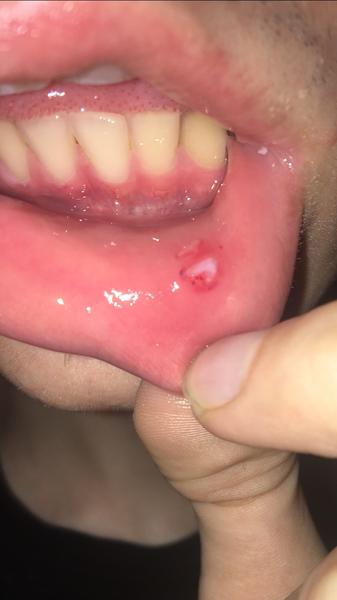 Môže sa malá rana na pere zapáliť?