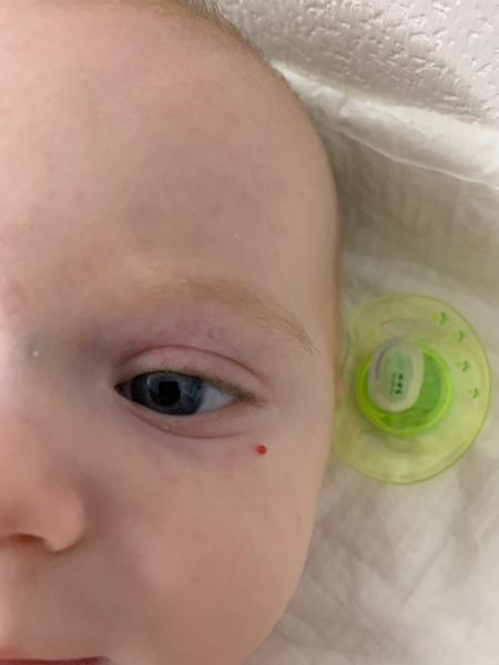 Červený výrastok pod okom trojmesačného syna