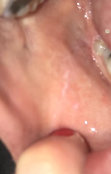 Aké biele škvrny to mám na lícach?