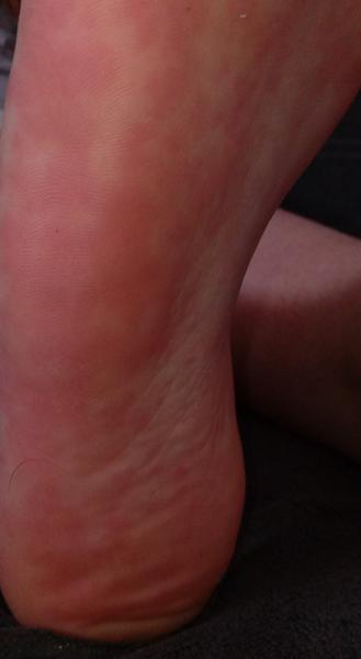 Môže mať dcérka alergickú reakciu na mandle?