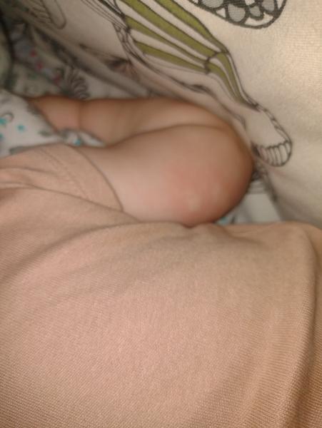 Má môj 9-mesačný syn žihľavku alebo nejakú alergiu?