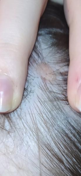 Na hlave mám znamienko