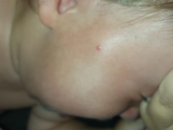 Týždeň mám vyrážky