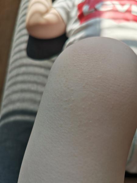 Vyrážky na synových kolenách