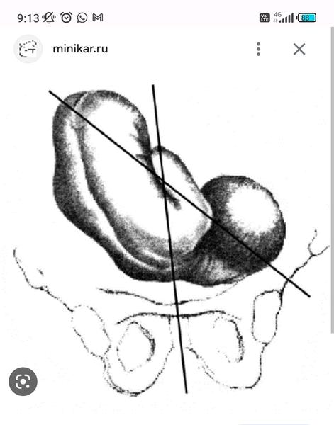 Poloha plodu pred pôrodom