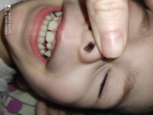 Dvojročná dcérka má niečo v nose