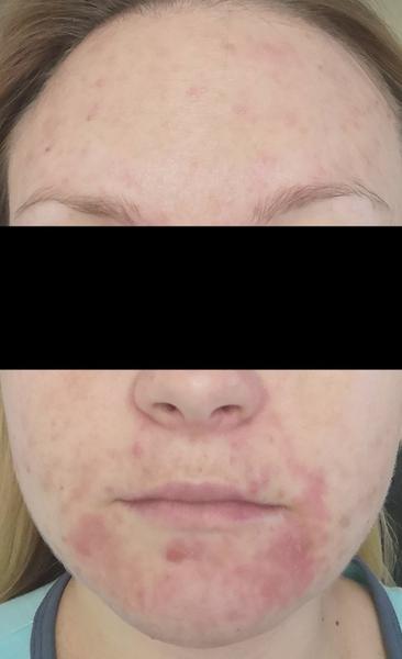 Ku koncu tehotenstva sa mi zhoršilo akné a urobila sa mi lišaj. Čo mi odporúčate?