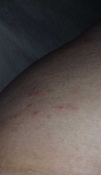 Čo spôsobuje červené bodky po tele?