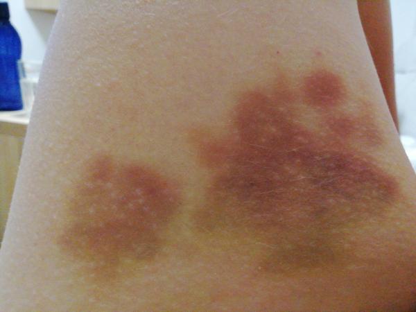 Prečo mám modrinu na stehne 13 týždňov po cisárskom reze?