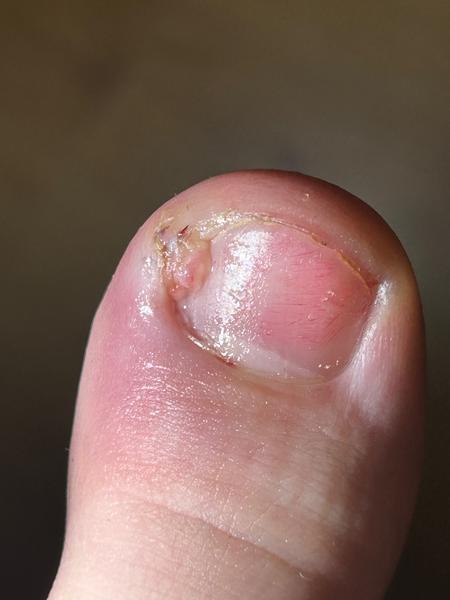 Čo spôsobuje problémy s palcom na nohe?