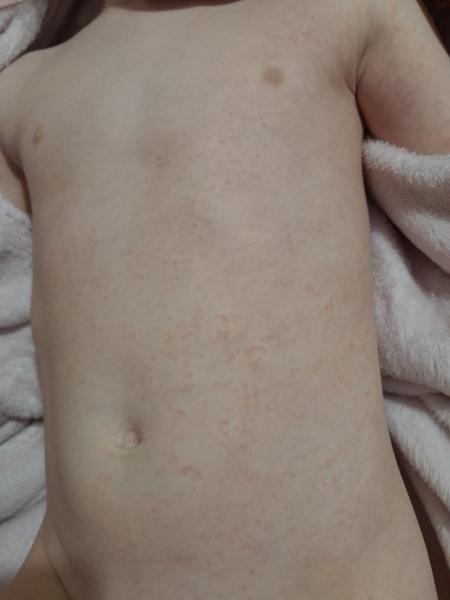 Bodky po tele 3-ročnej