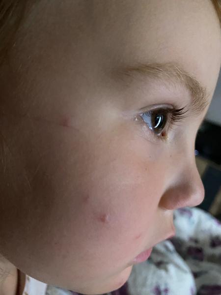 Môžu byť toto začínajúce kiahne?