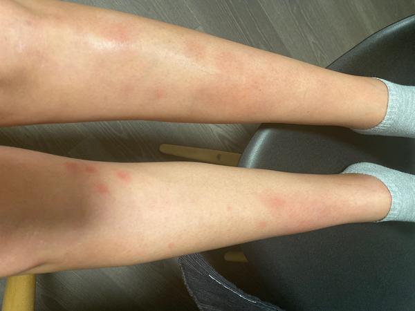 Prečo sa mi robia červené fľaky na píšťalách?