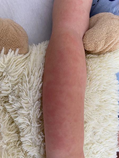 Čo spôsobuje výsev na lícach a rukách?