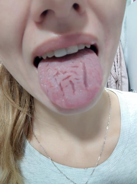 Mám trhliny na jazyku
