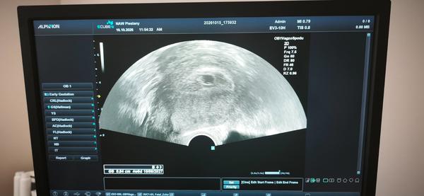 Skúsenosti s neviditeľným embryom a strach z missed abortion