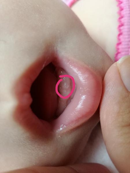 Nie som si istá, či je to rastom zubov alebo infekciou