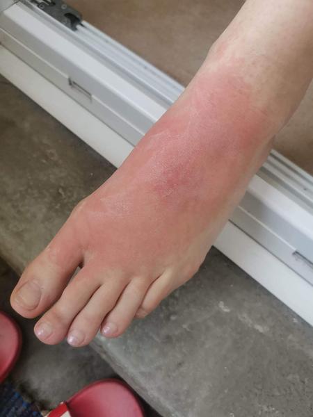 Ako sa zbaviť extrémnej alergie na chlad?