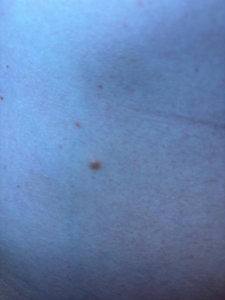 Je to znamienko, vyrážka alebo niečo iné?