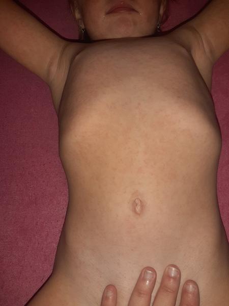 Aký výsyp má moje dieťa?