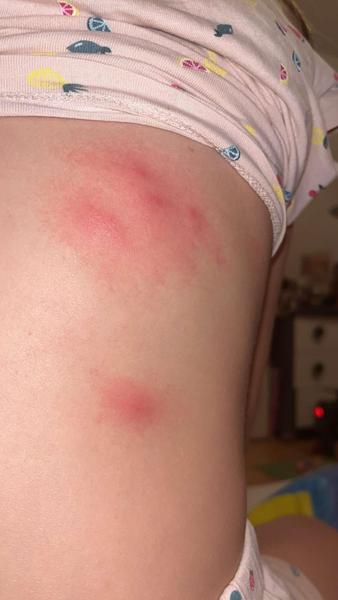 Čo sú to za štípance?