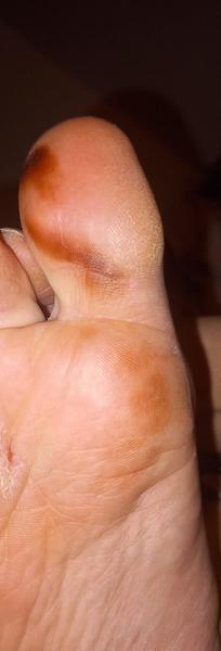 Hnedá škvrna na chodidle: Čo môže znamenať?