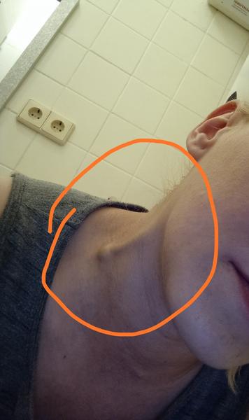 Z čoho mám navretú žilu?