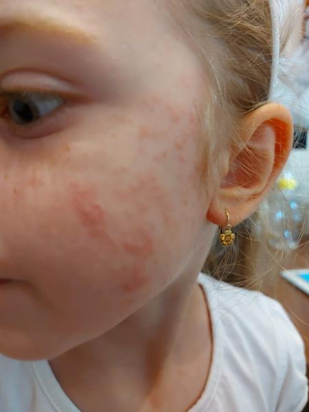 Vyrážky na lícach 5 ročnej dcéry