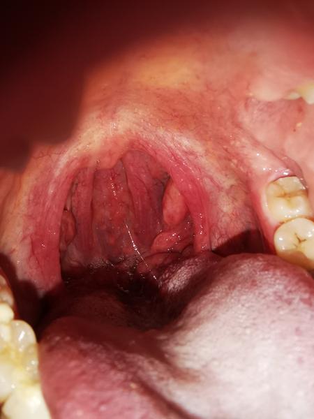 Sú v poriadku hrbolčeky dole pod mandľami?