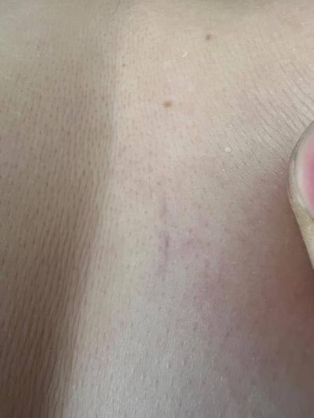 Fialová cievka na chrbte. Je to nebezpečné?