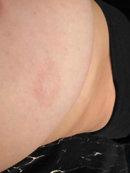 Môže to byť svrab?