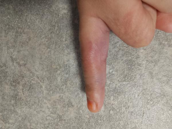 Je prst zlomený alebo len narazený?