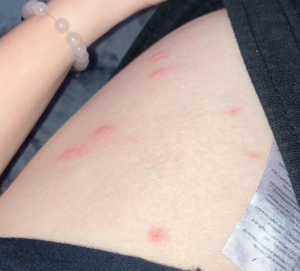 Príčiny neznámych štípancov na tele