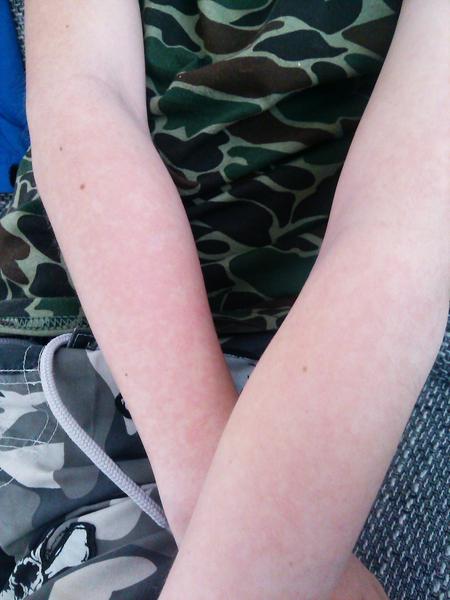 Má aj vaše dieťa alergiu na slnko?