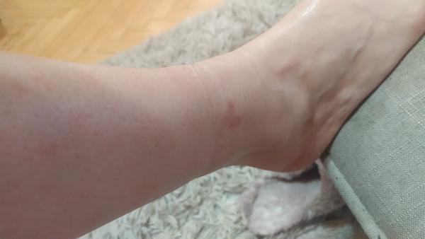 Ako zistiť, čo sú vyrážky na nohách?