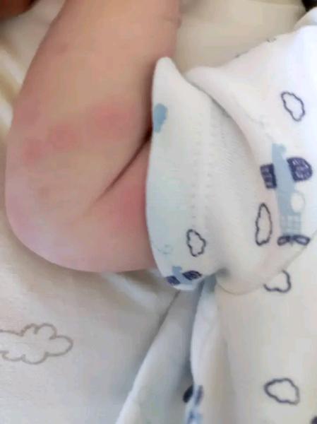 Aké červené fľaky má môj 5-týždňový synček?