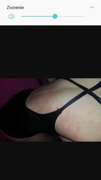 Má dcérka alergiu?