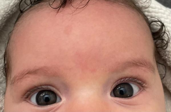 Bábätko má škvrnu na čele. Je to znamienko?